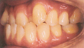 前歯の乱ぐいの治療