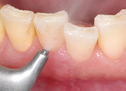 歯と歯の間をクリーニング